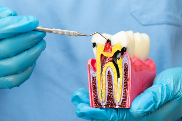 Root Canal Therapy